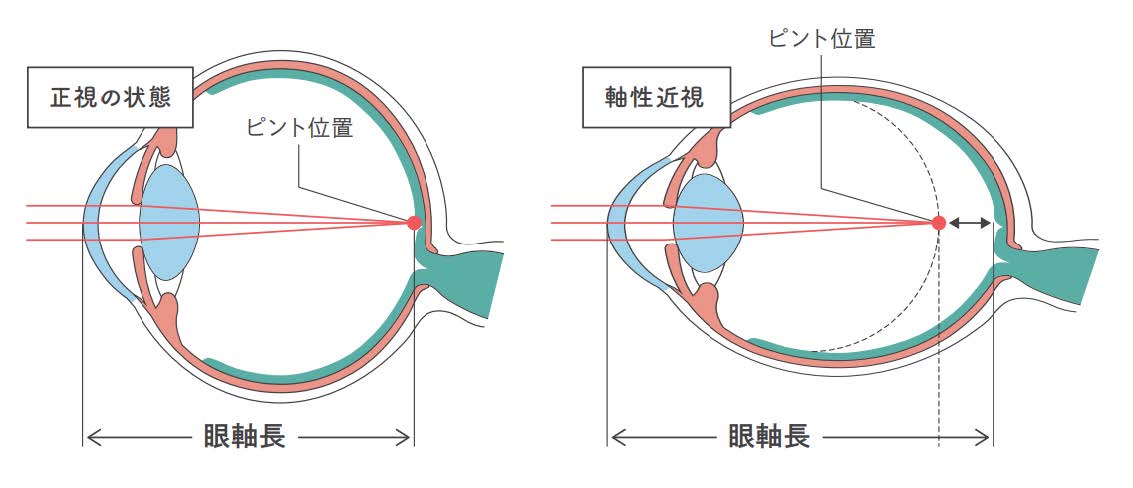 近視の仕組み